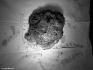医者仁心，不畏凶险，点燃生命奇迹！旭东助力中山大学附属第七医院胸外科团队挽救青春少年！