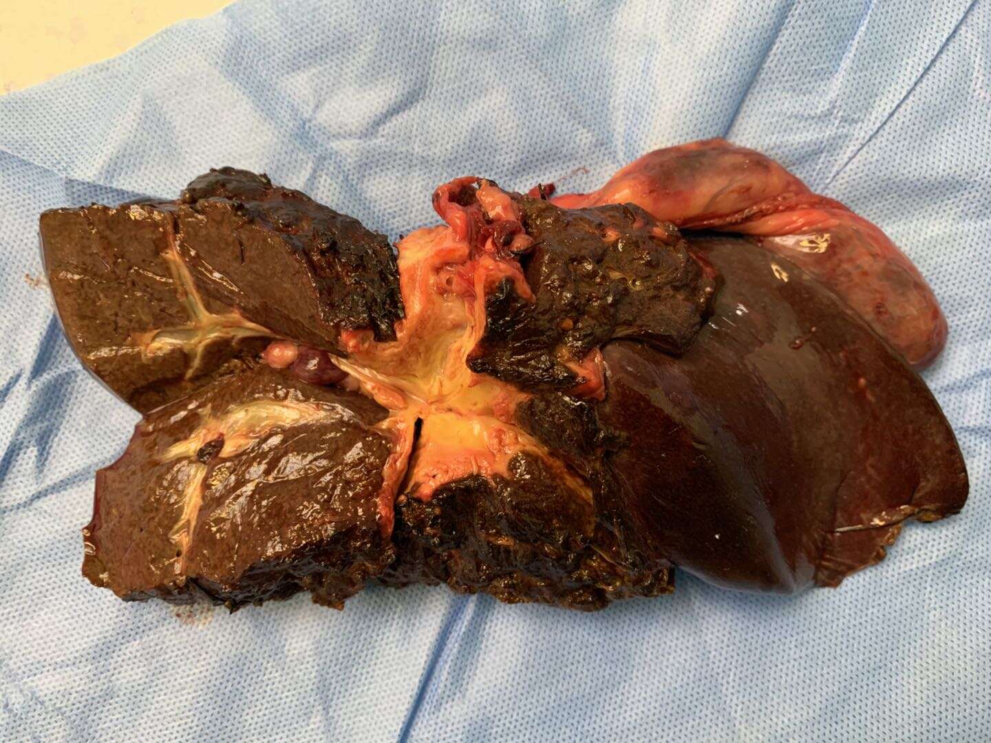 [精准诊疗]三维可视化指导复杂性肝门部胆管癌计划性肝切除！