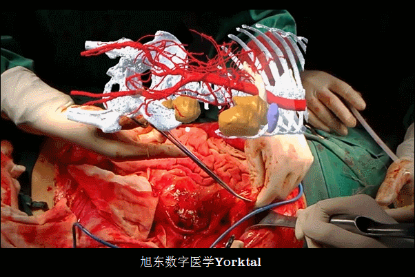 3D+MR术中导航.gif